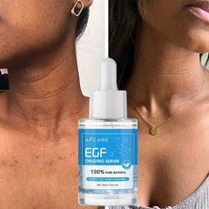 AFCARE EGF Origin Serum for effective acne removal in a clear dropper bottle with a model applying the treatment