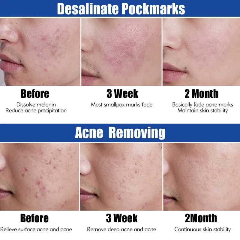 AFCARE Desalinate Pockmarks Treatment Results for Acne Removal Over Two Months