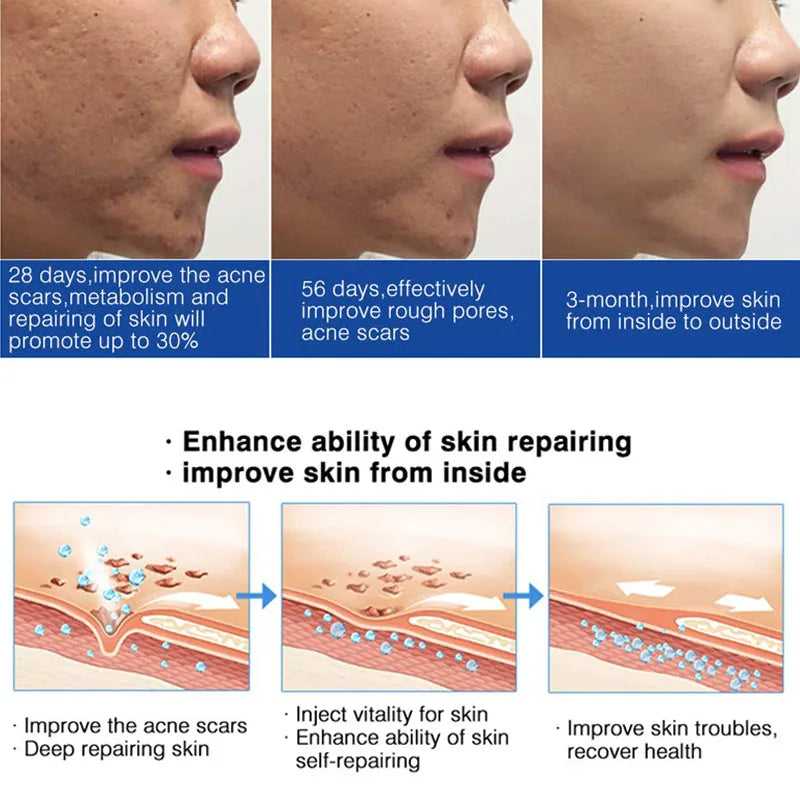 AFCARE Skin Treatment Process Showing Improvement of Acne Scars and Skin Repair Over Time