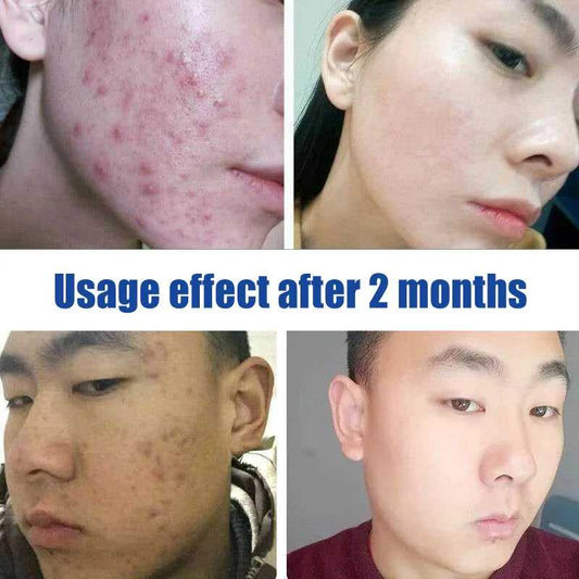 AFCARE acne treatment results showcasing skin improvement after two months of use
