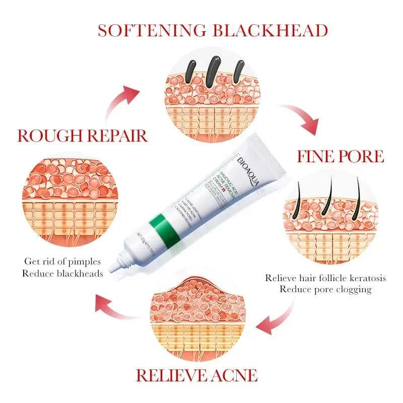 SAKSRAAR Blackhead Treatment Cream for Relieving Acne and Reducing Pore Clogging