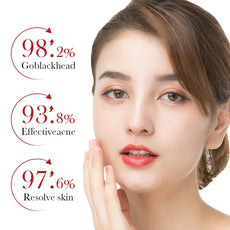 SAKSRAAR skin treatment showcasing effective results for reducing blackheads and improving skin clarity