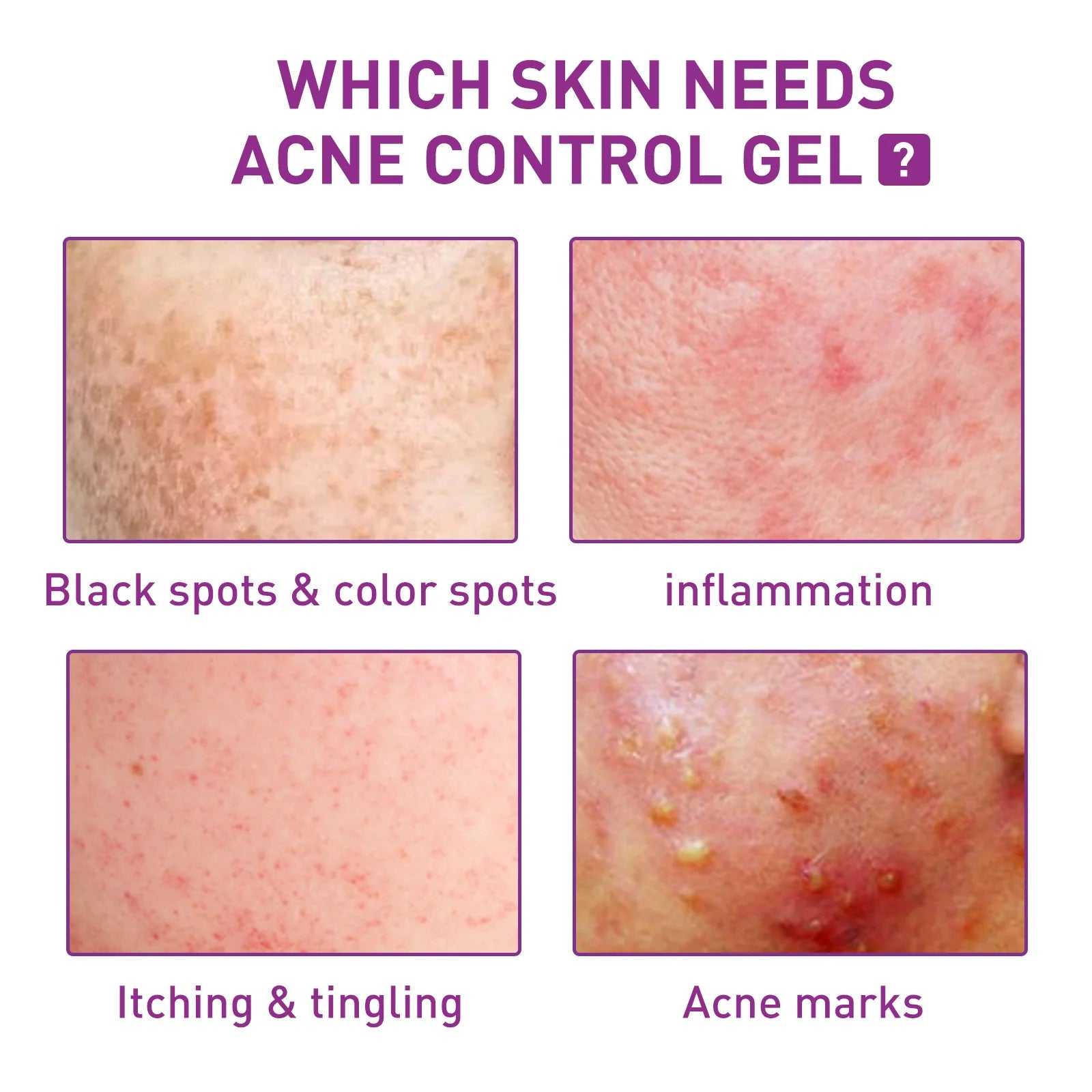 EELHOE Acne Control Gel infographic showing various skin conditions needing treatment like inflammation and black spots