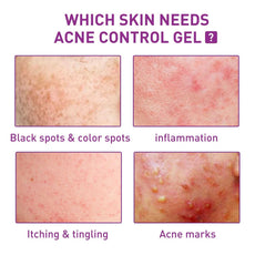 EELHOE Acne Control Gel infographic showing various skin conditions needing treatment like inflammation and black spots