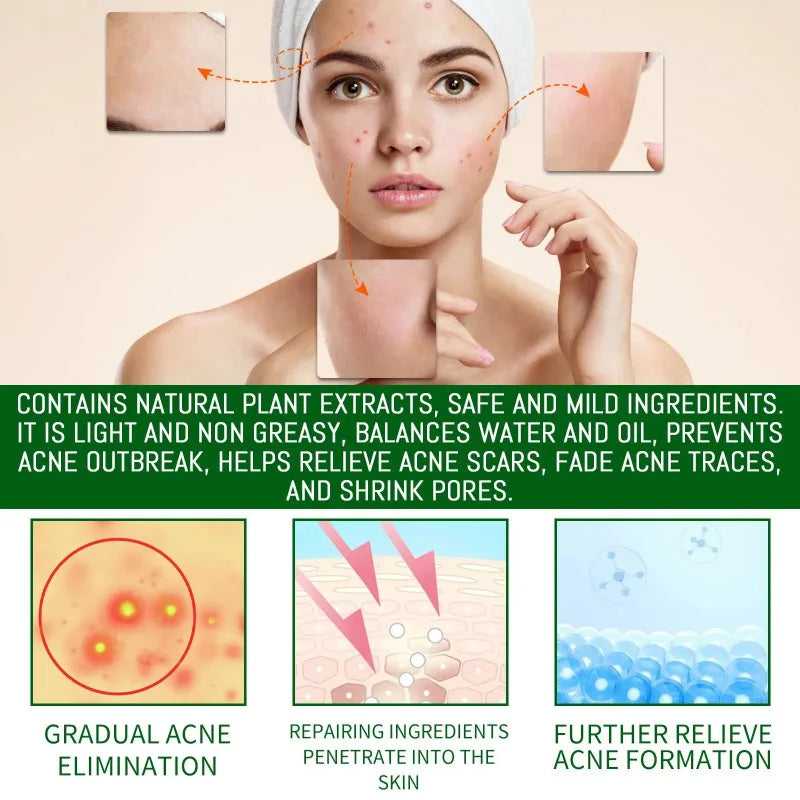 jaysuing salicylic acid acne serum for gradual acne elimination and scar relief, featuring natural plant extracts