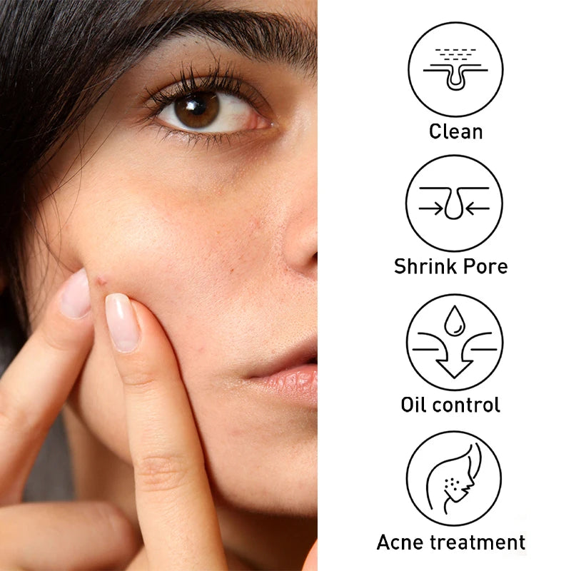 JoyPrettyin Acne Treatment with Oil Control Features for Clean and Shrink Pores