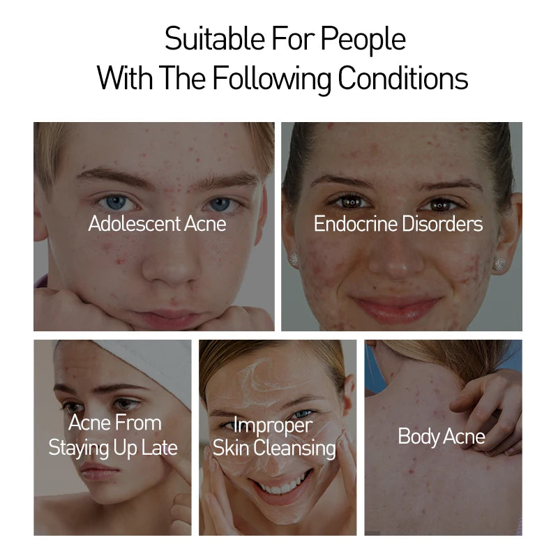 JoyPrettyin Acne Treatment Solutions for Adolescent and Body Acne with Skincare Tips