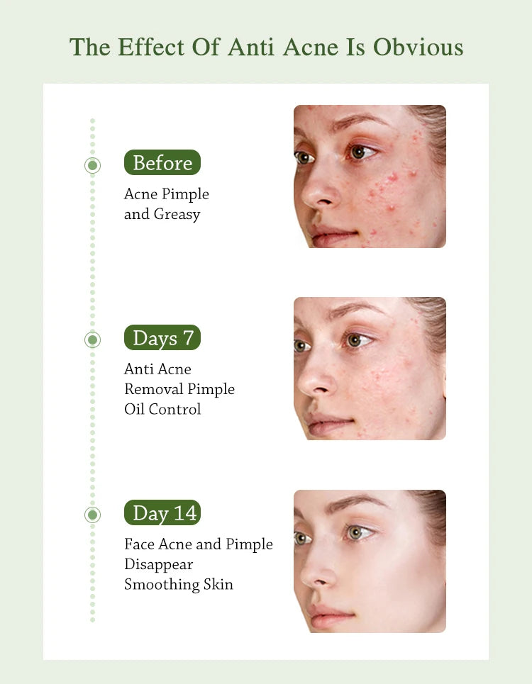 Before and after images showing JoyPrettyin anti-acne treatment effect on skin over 14 days