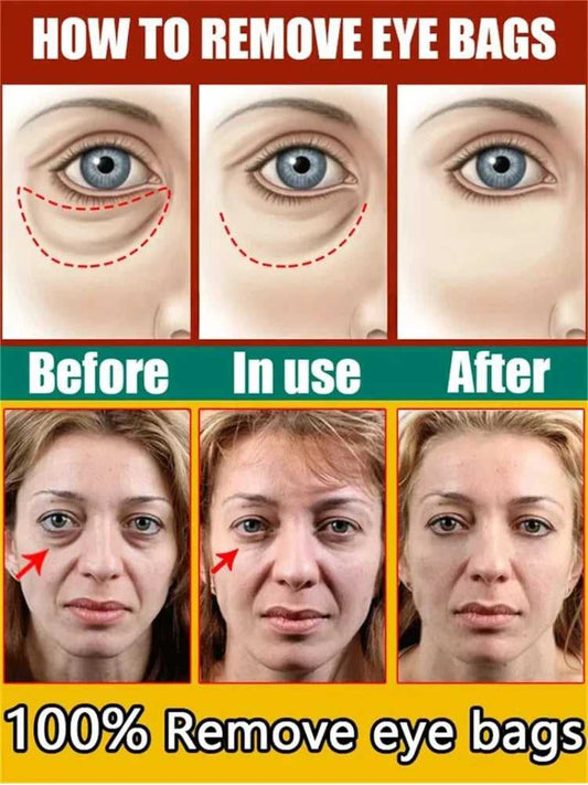 Step-by-step eye care guide to remove eye bags, showcasing before and after results