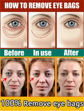 Step-by-step eye care guide to remove eye bags, showcasing before and after results